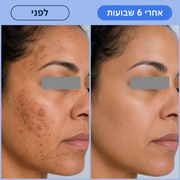מארז ההבהרה של MAYRO לפיגמנטציה ולגוון עור לא אחיד